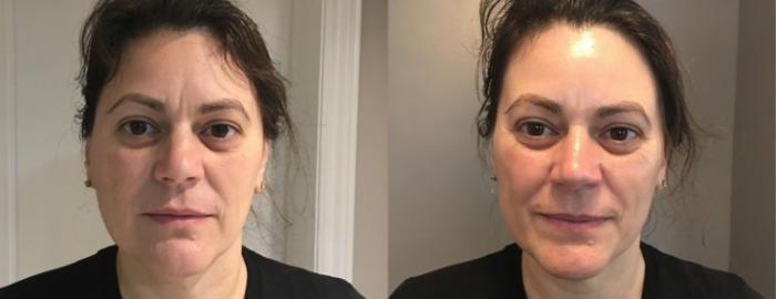 GLOW PEEL THERAPY