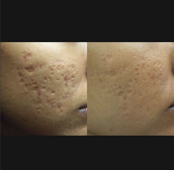 ACNE SCARS REDUCTION THERAPY