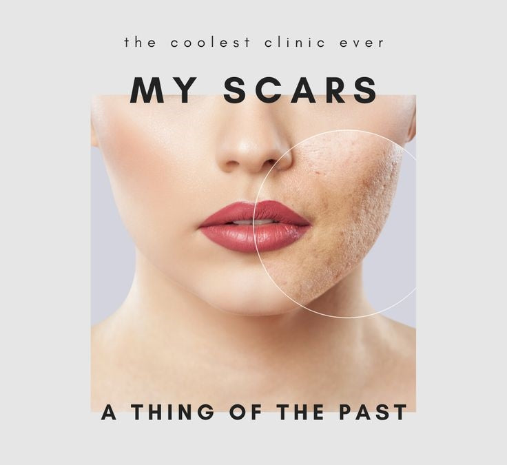 ACNE SCARS REDUCTION THERAPY