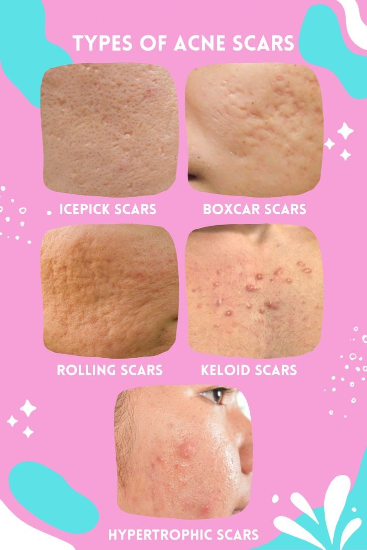 ACNE SCARS REDUCTION THERAPY