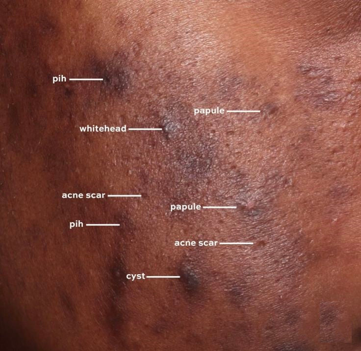 ACNE SCARS REDUCTION THERAPY