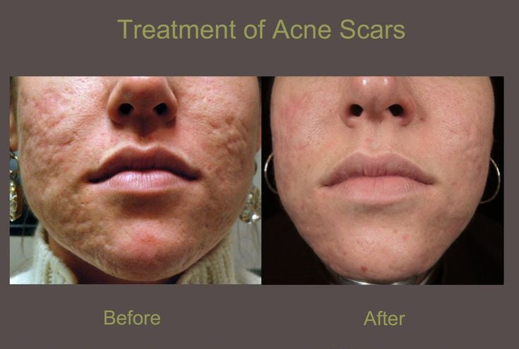 ACNE SCARS REDUCTION THERAPY