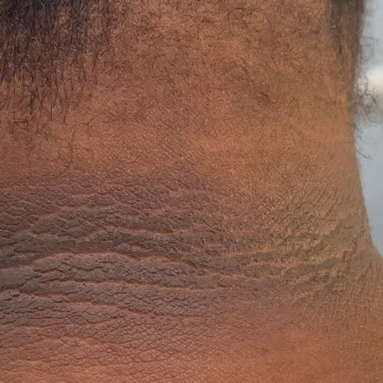 ANY BODY PARTS EXFOLIATION ( PEELING )