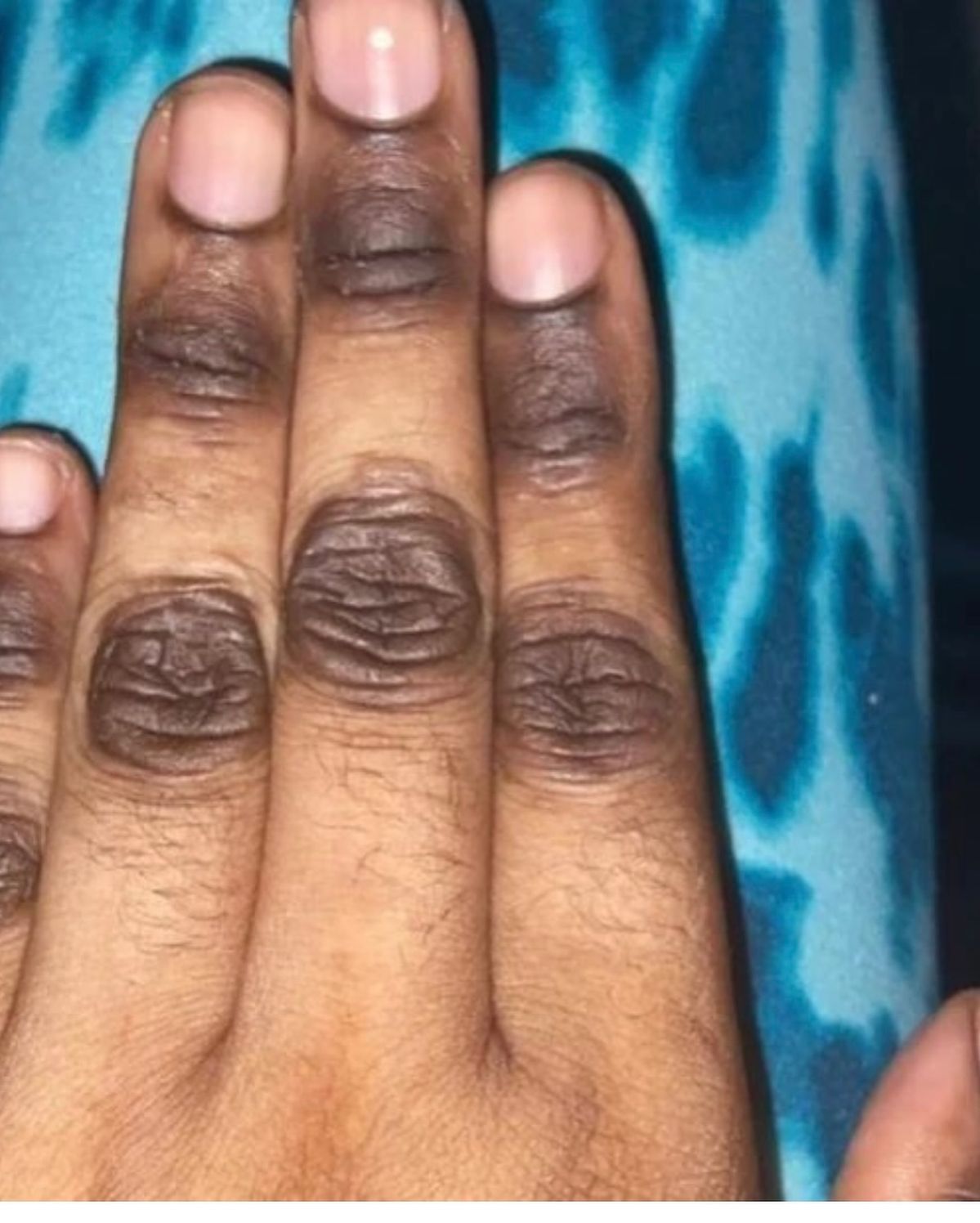 ANY BODY PARTS EXFOLIATION ( PEELING )