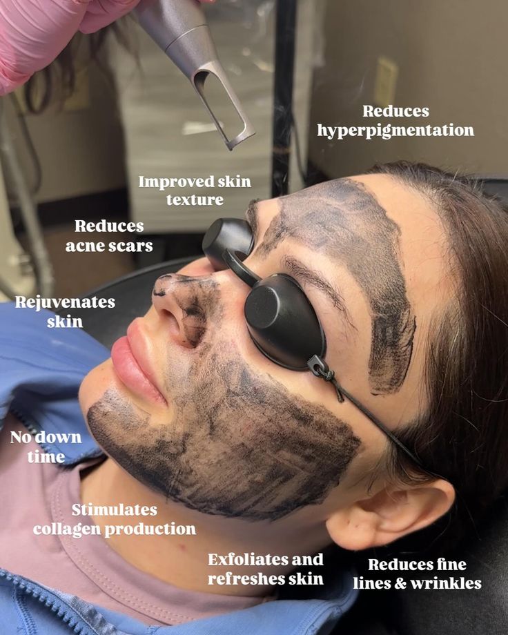 CARBON LASER FACIAL