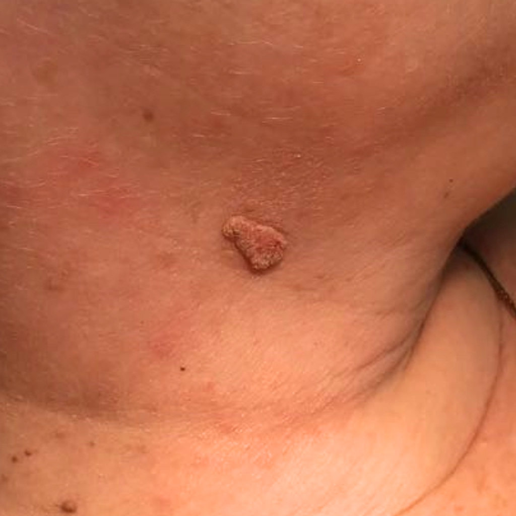 CAUTRY VERUCA WARTS REMOVAL THERAPY