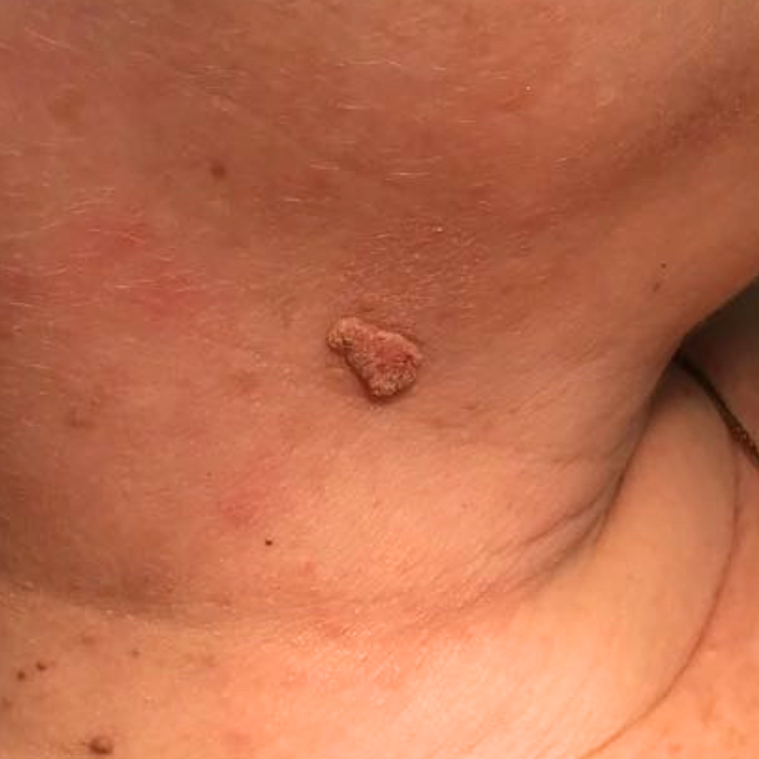 CAUTRY VERUCA WARTS REMOVAL THERAPY