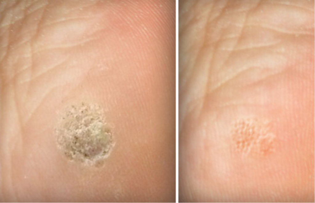 CAUTRY VERUCA WARTS REMOVAL THERAPY