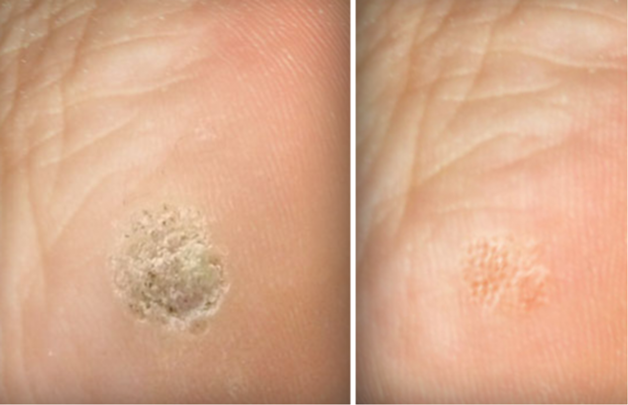 CAUTRY VERUCA WARTS REMOVAL THERAPY