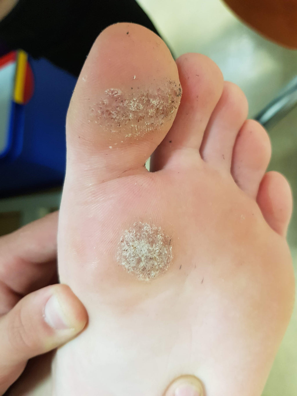 CAUTRY VERUCA WARTS REMOVAL THERAPY