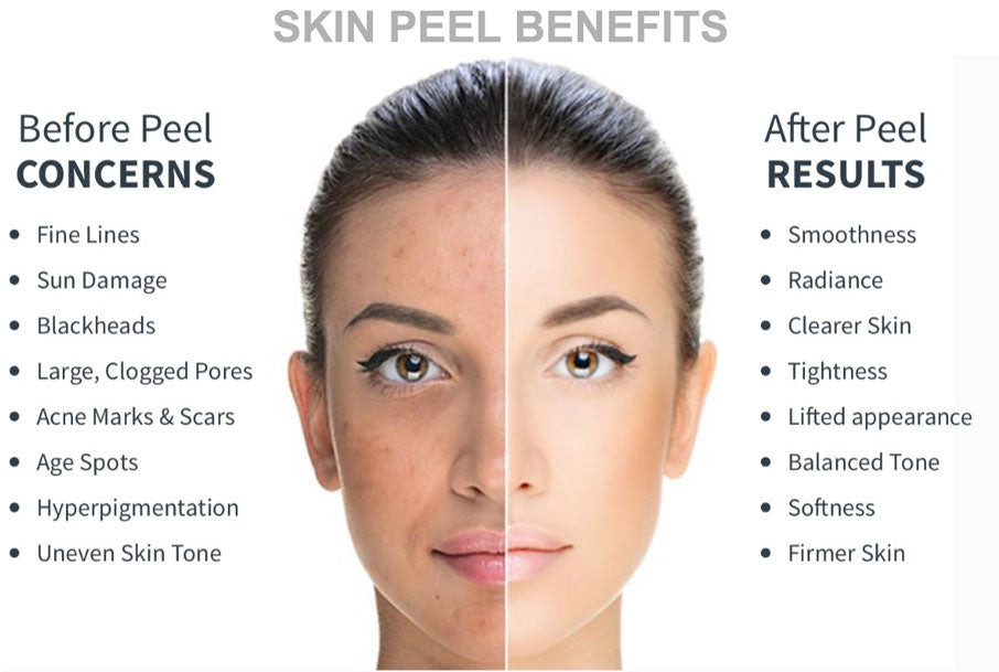 CHEMICAL PEELS THERAPY