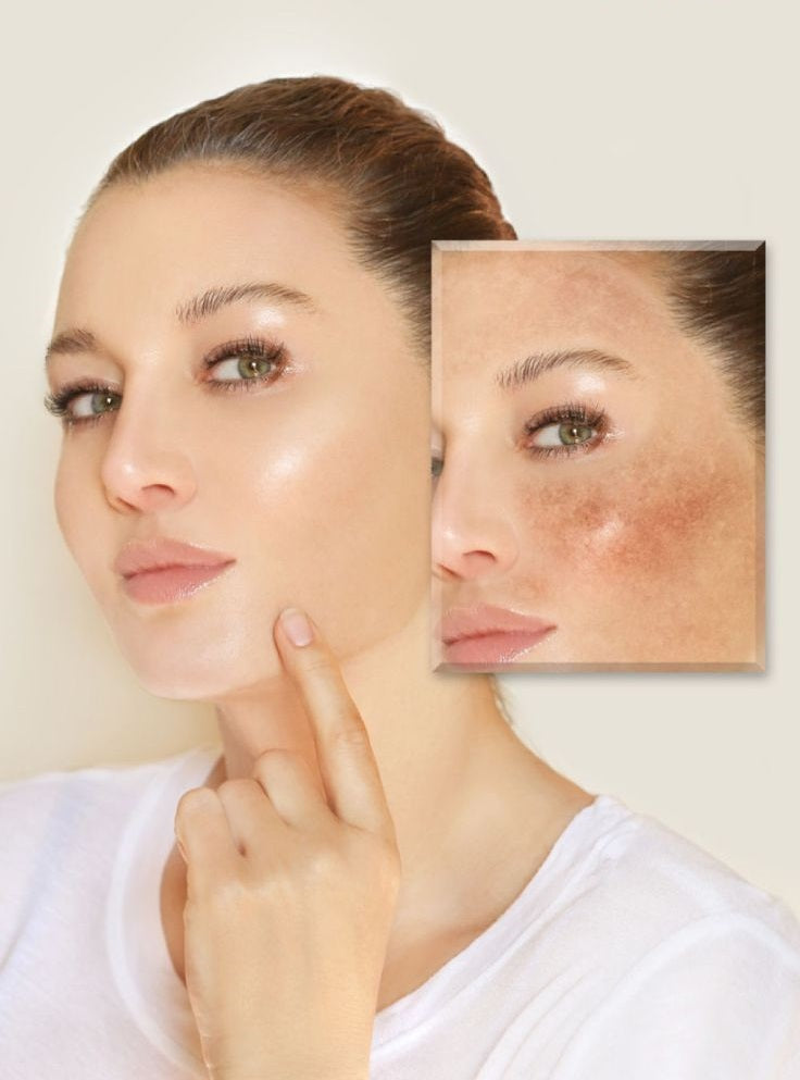 CHEMICAL PEELS THERAPY