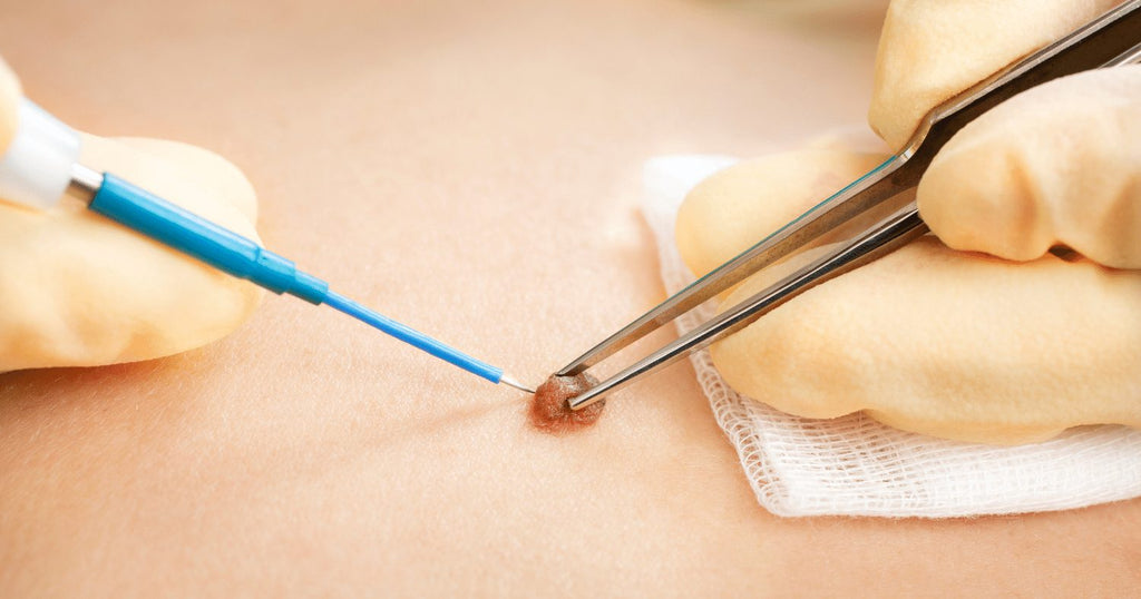 CO2 LASER MOLE REFINE THERAPY