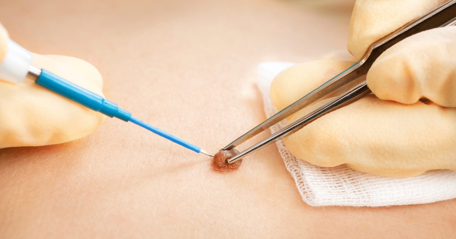 CO2 LASER MOLE REFINE THERAPY