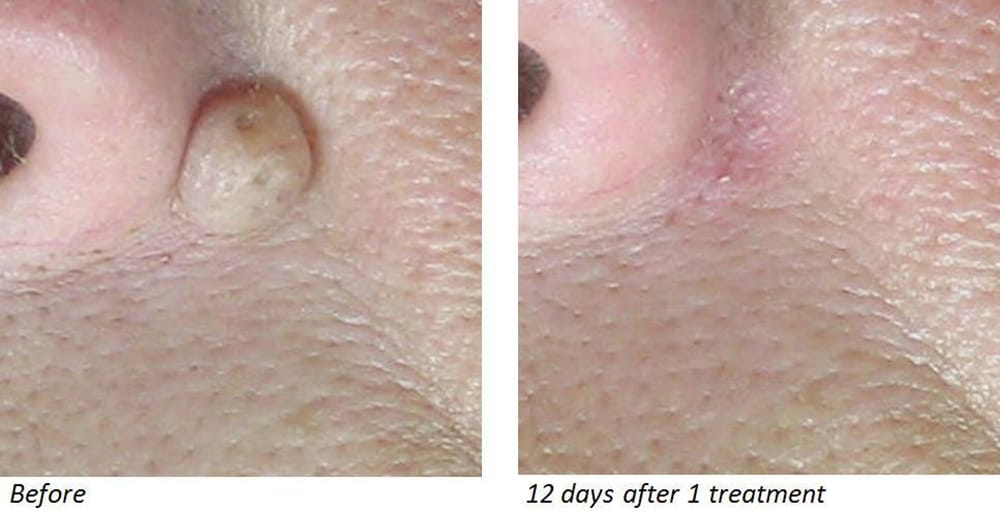 CO2 LASER MOLE REFINE THERAPY