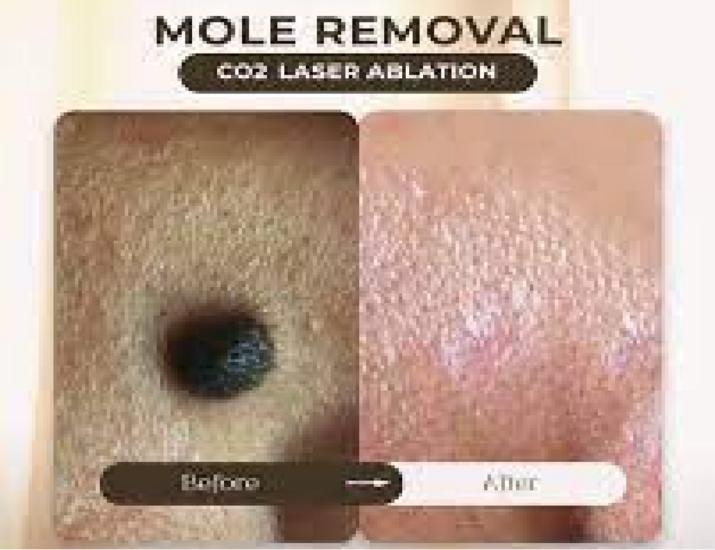 CO2 LASER MOLE REFINE THERAPY