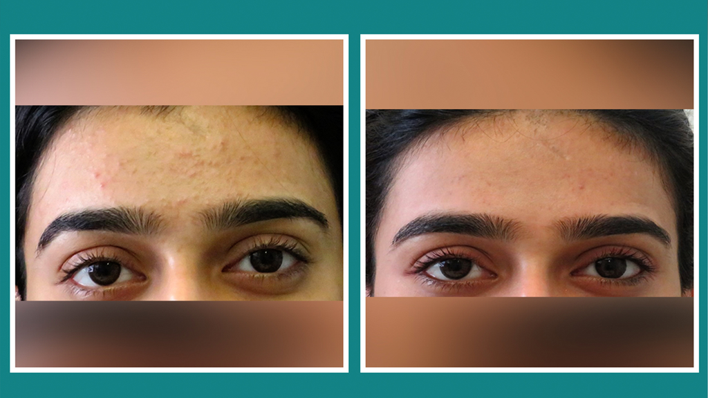 COMEDONE EXTRACTION THERAPY