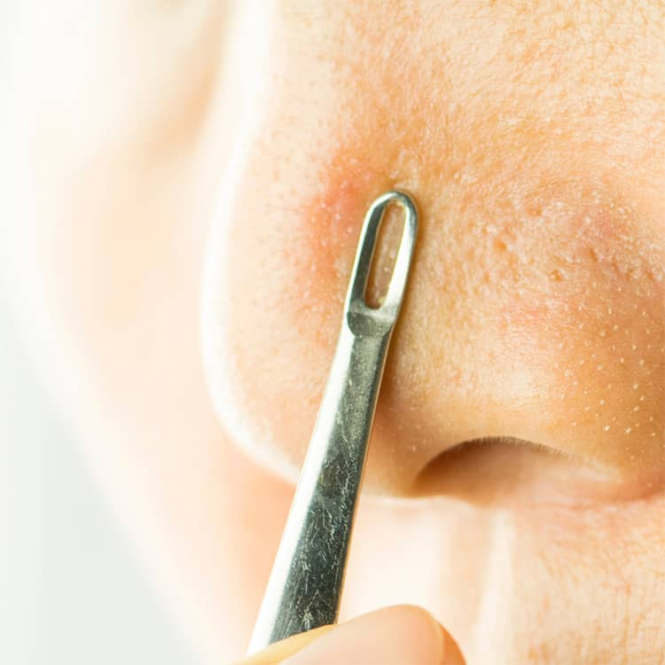 COMEDONE EXTRACTION THERAPY