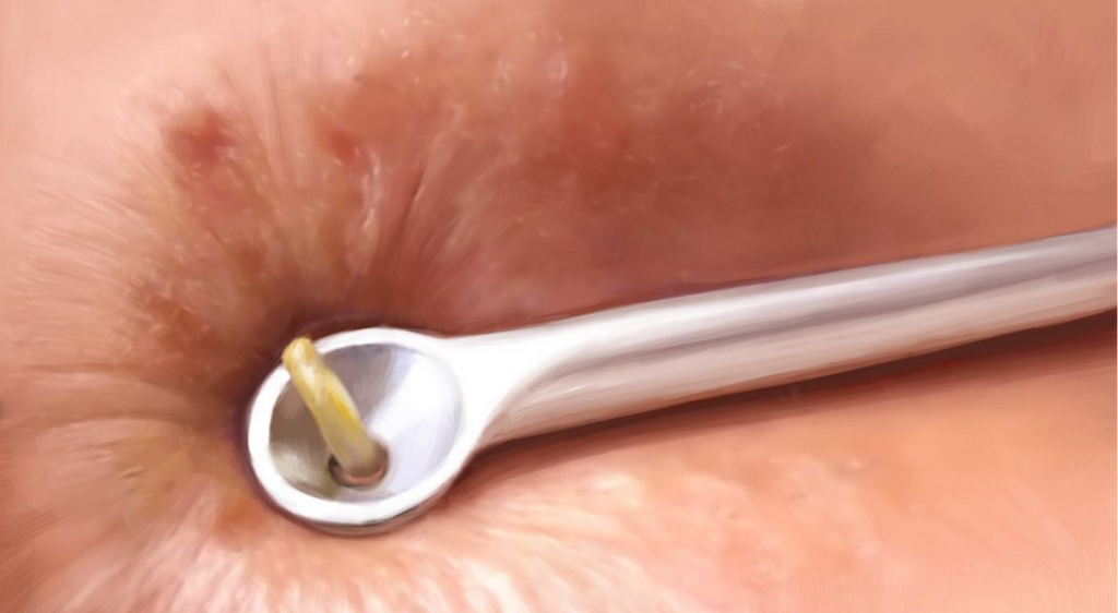 COMEDONE EXTRACTION THERAPY