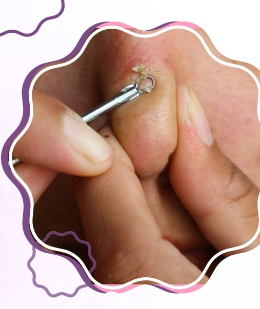 COMEDONE EXTRACTION THERAPY