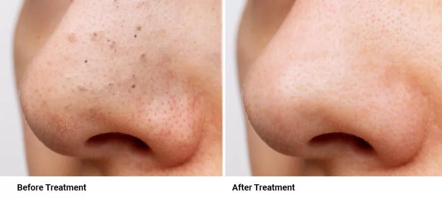 COMEDONE EXTRACTION THERAPY