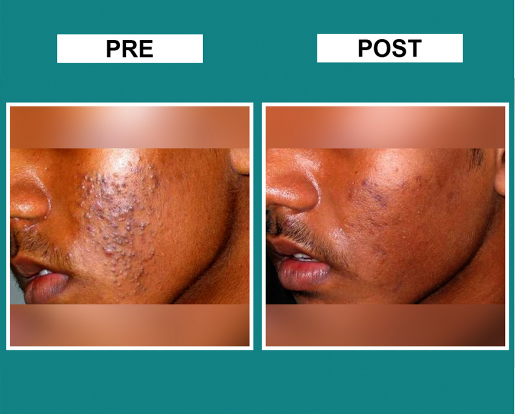 COMEDONE EXTRACTION THERAPY