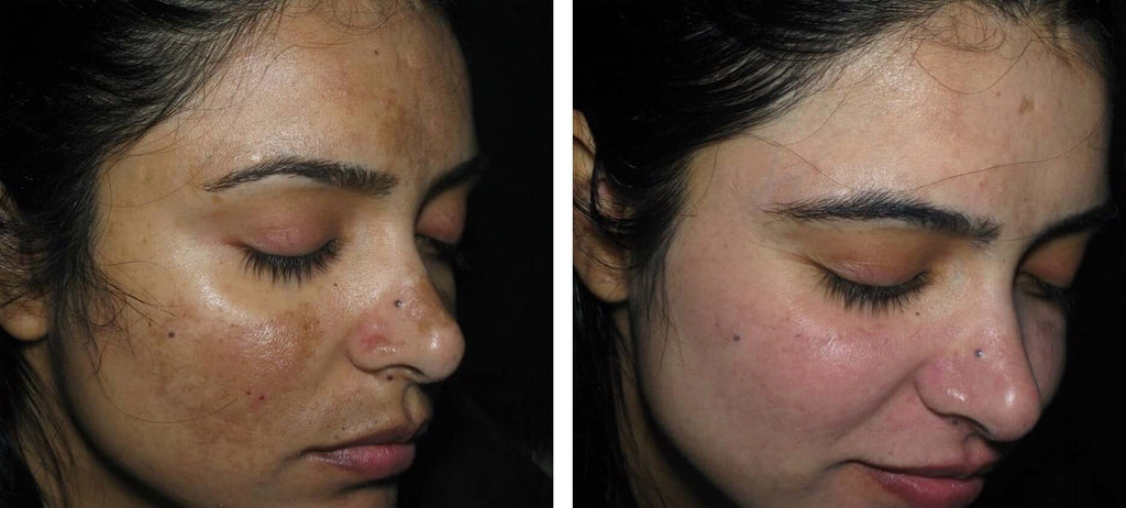 DEEP PIGMENTATION REDUCTION THERAPY