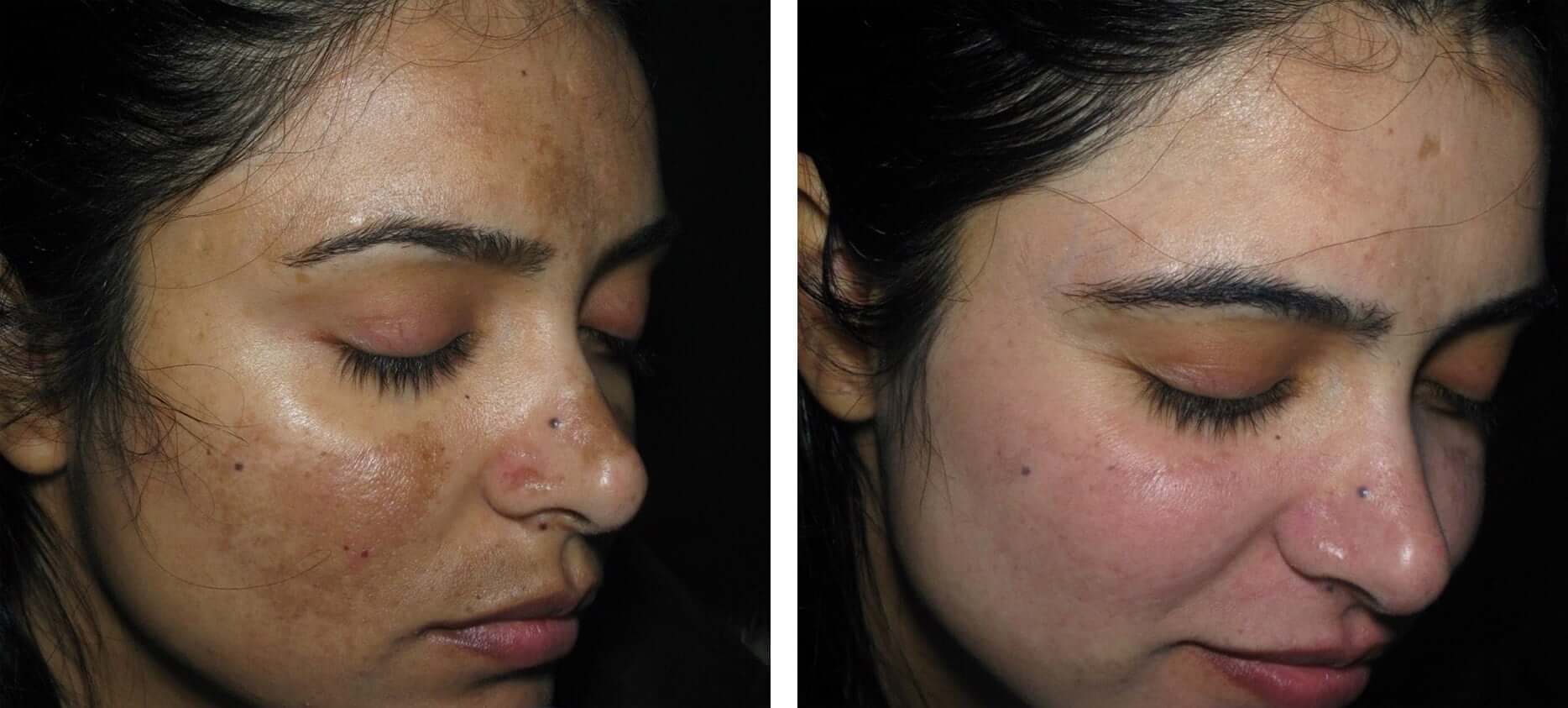 DEEP PIGMENTATION REDUCTION THERAPY