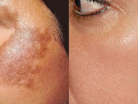 DEEP PIGMENTATION REDUCTION THERAPY