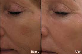 DEEP PIGMENTATION REDUCTION THERAPY