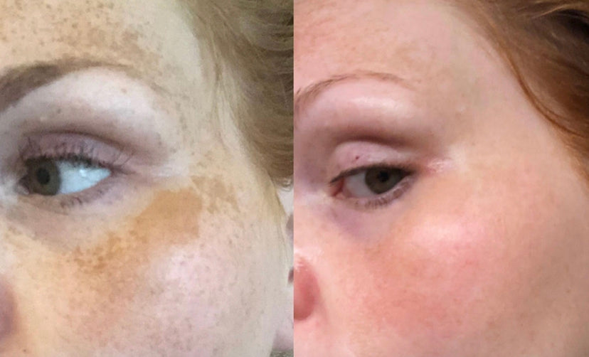 DEEP PIGMENTATION REDUCTION THERAPY