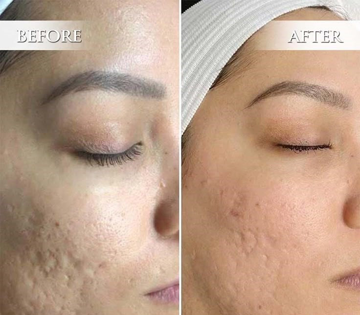 DERMAPEN MICRONEEDLING THERAPY