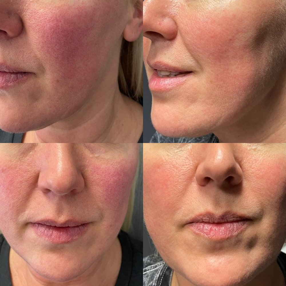 DERMA STAMPING THERAPY