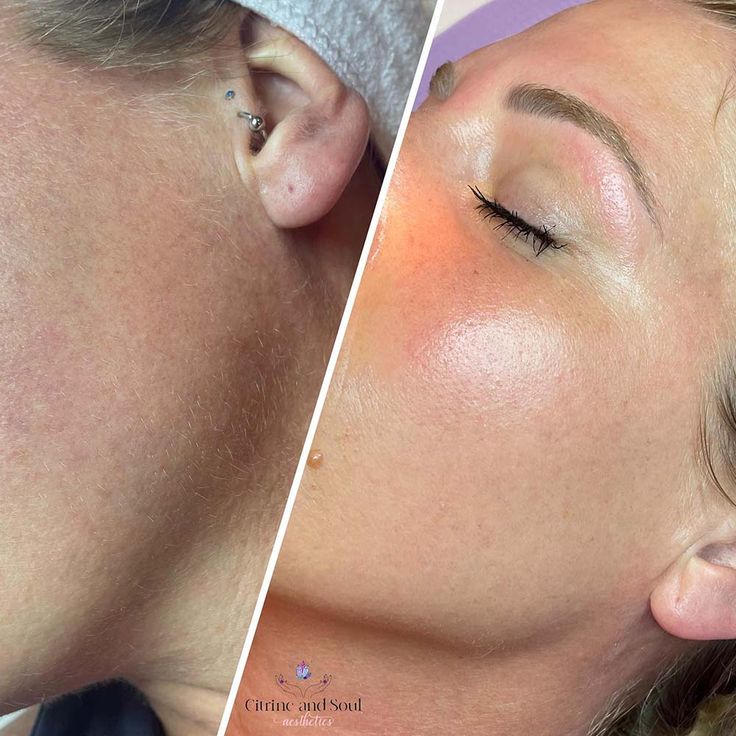 DERMA PLANNING FACIAL