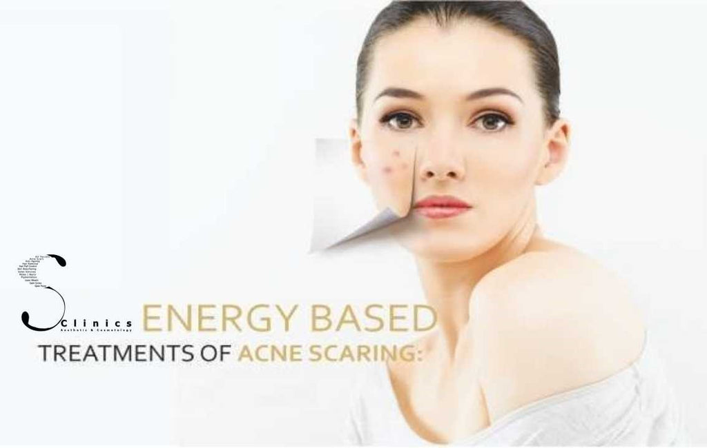 ENERGY BASED ACNE THERAPY