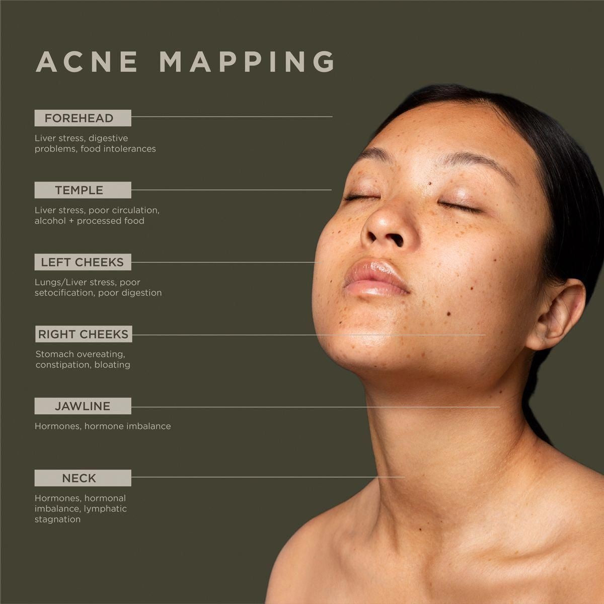 ENERGY BASED ACNE THERAPY