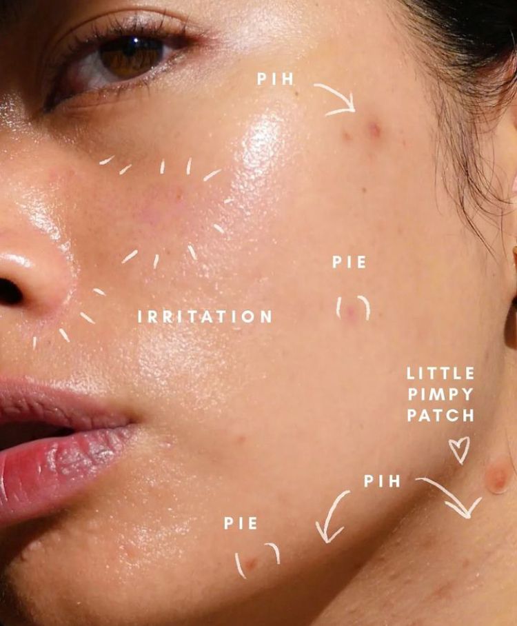 ENERGY BASED ACNE THERAPY