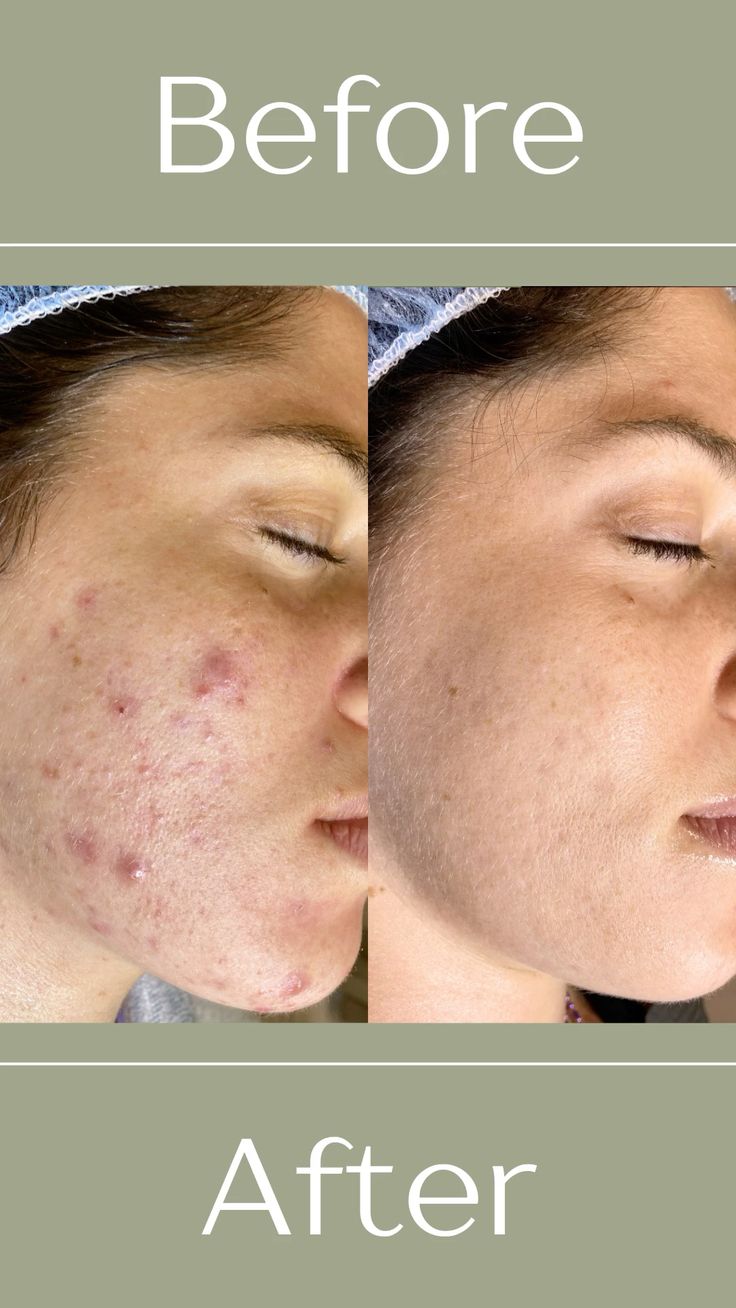 ENERGY BASED ACNE THERAPY