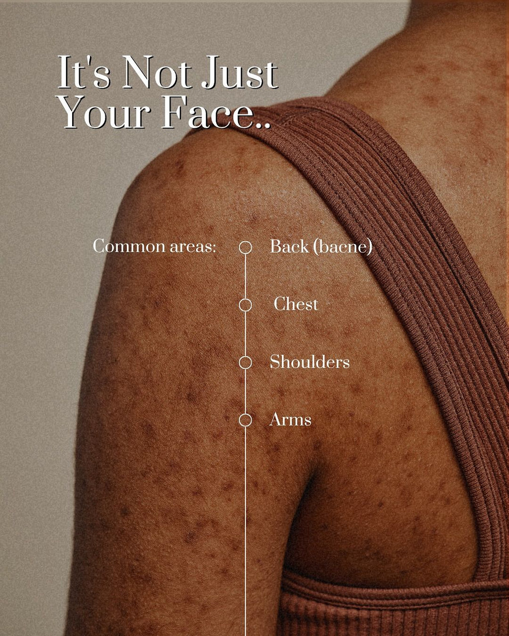 ENERGY BASED ACNE THERAPY