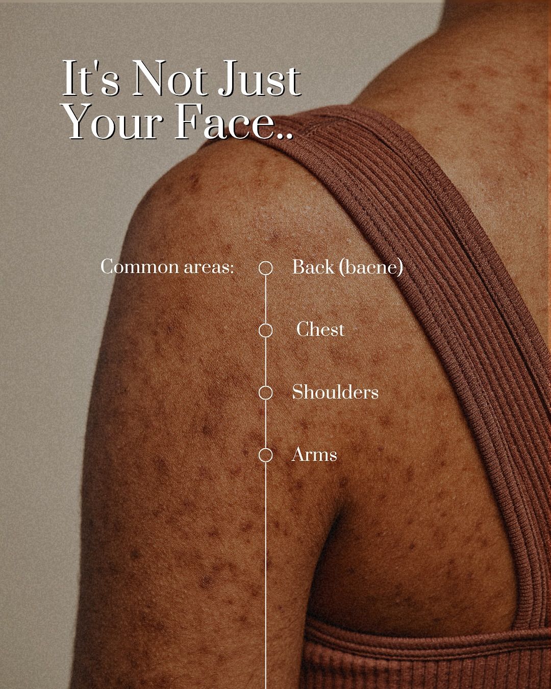 ENERGY BASED ACNE THERAPY