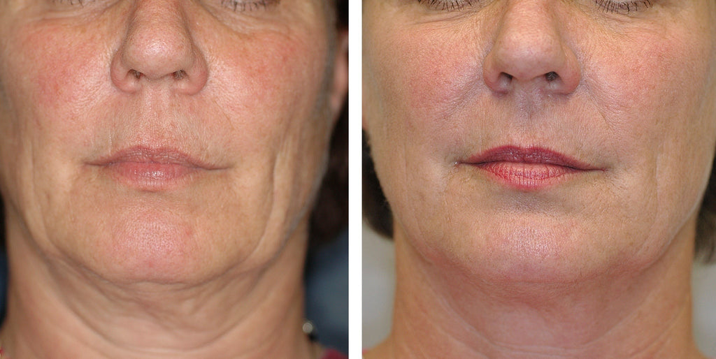 FACE FIRMING FACIAL THERAPY