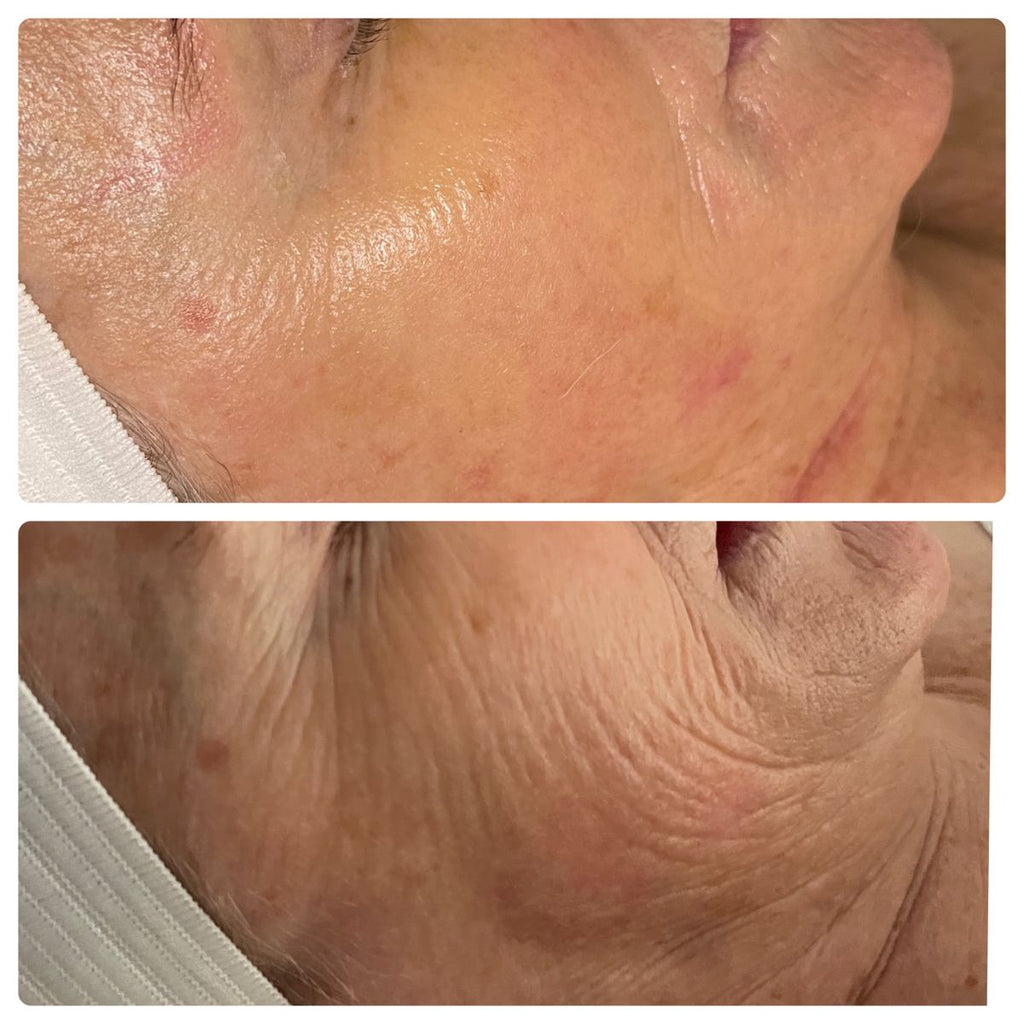 FACE FIRMING FACIAL THERAPY