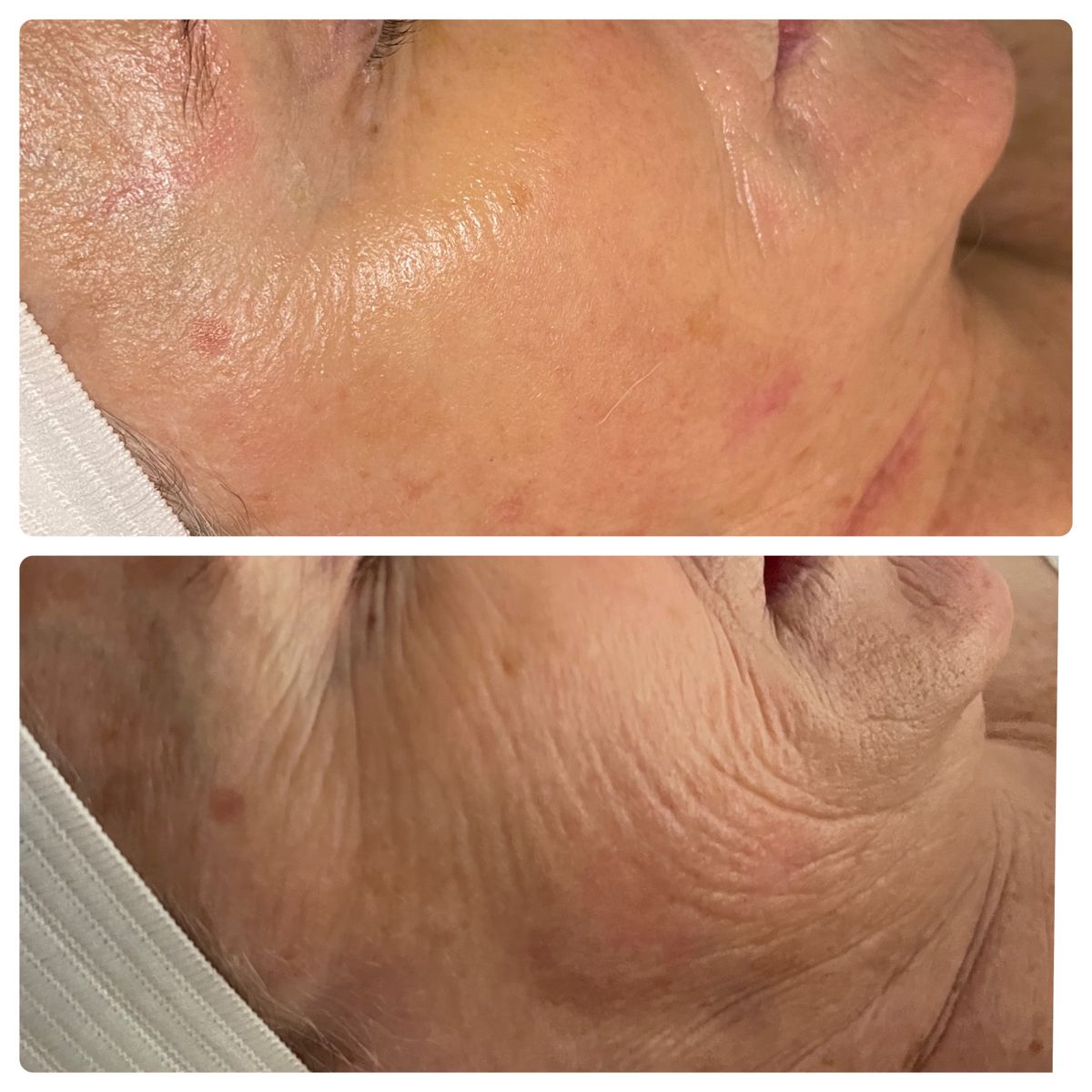 FACE FIRMING FACIAL THERAPY