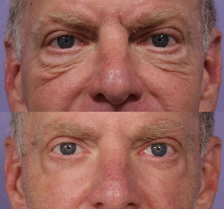 FOCUSED EYELID AND UNDER EYE CARE