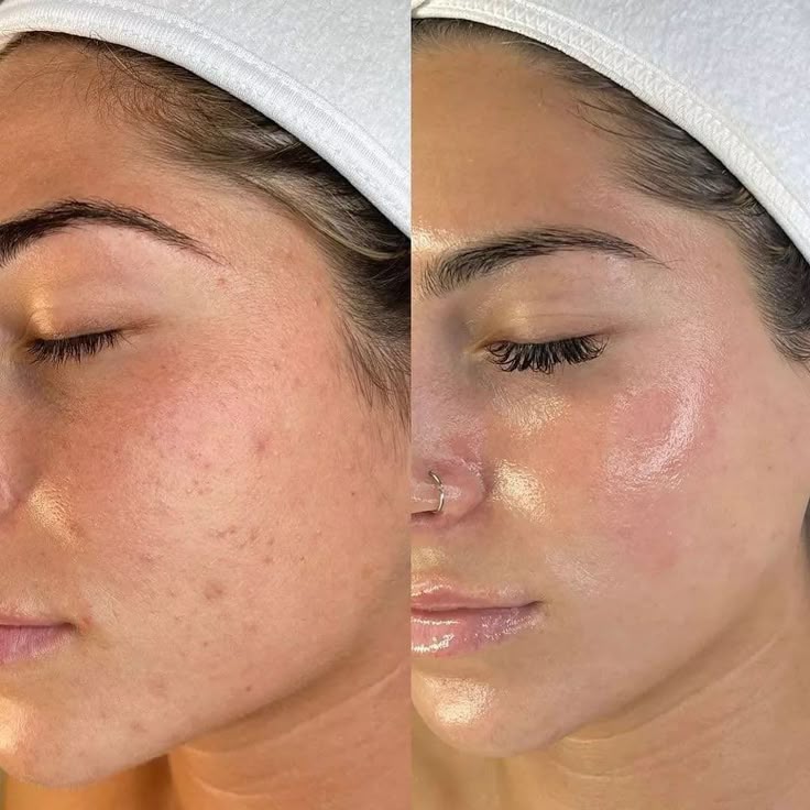 GLOW PEEL THERAPY