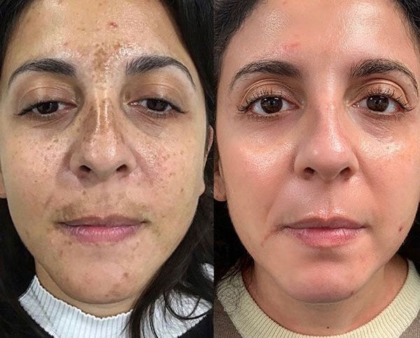 GLOW PEEL THERAPY