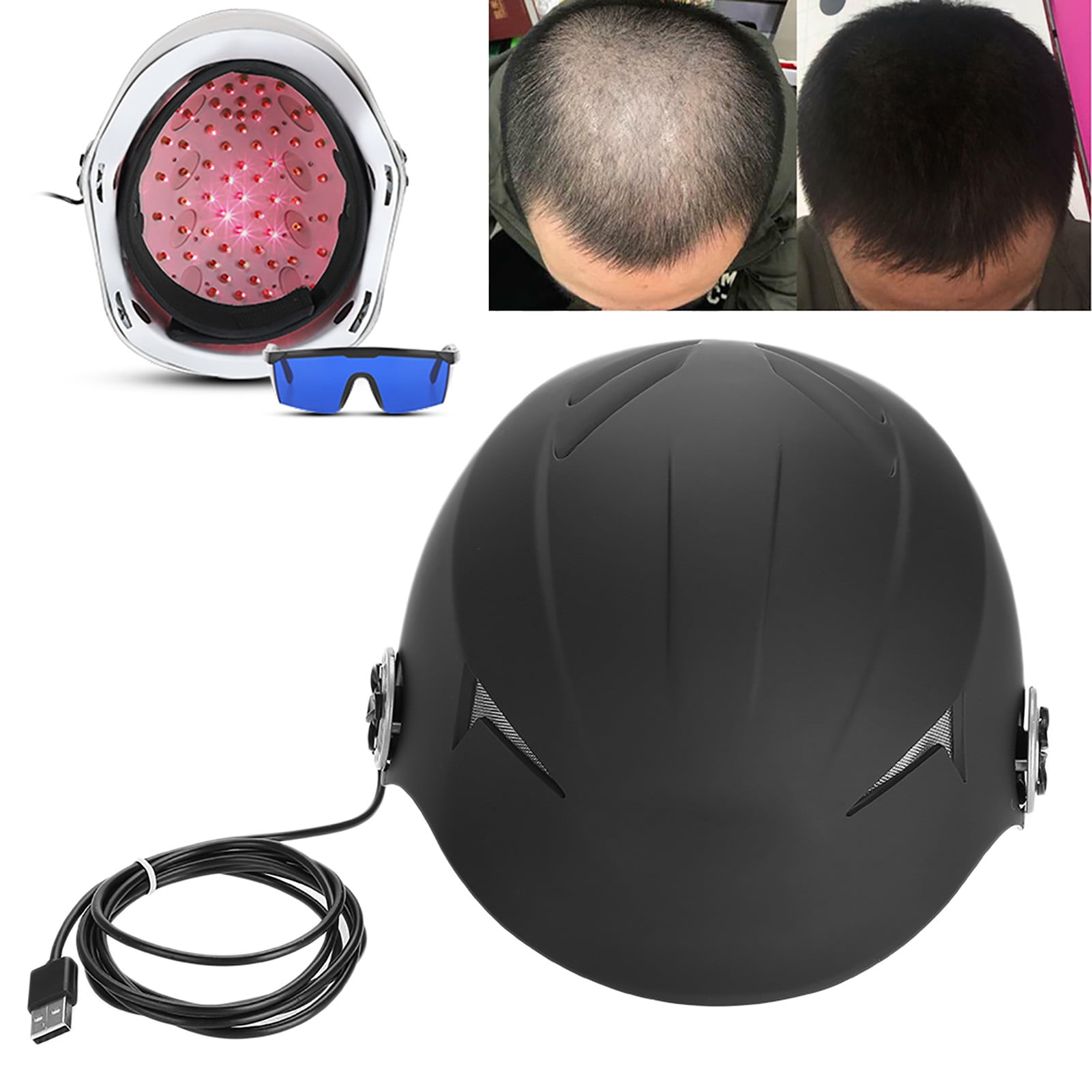 HAIR REGROWTH WITH DIODE HELMET THERAPY