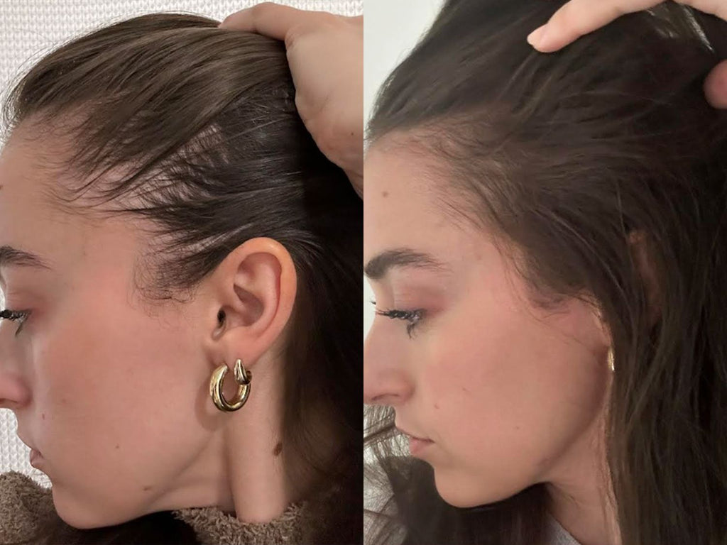 HAIR RE-GROWTH THERAPY