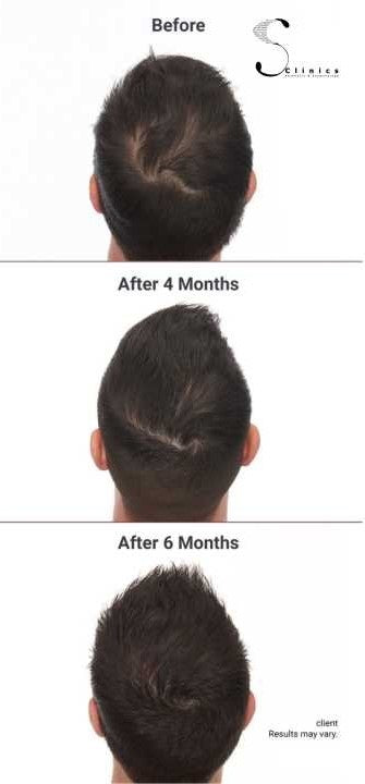 HAIR RE-GROWTH THERAPY
