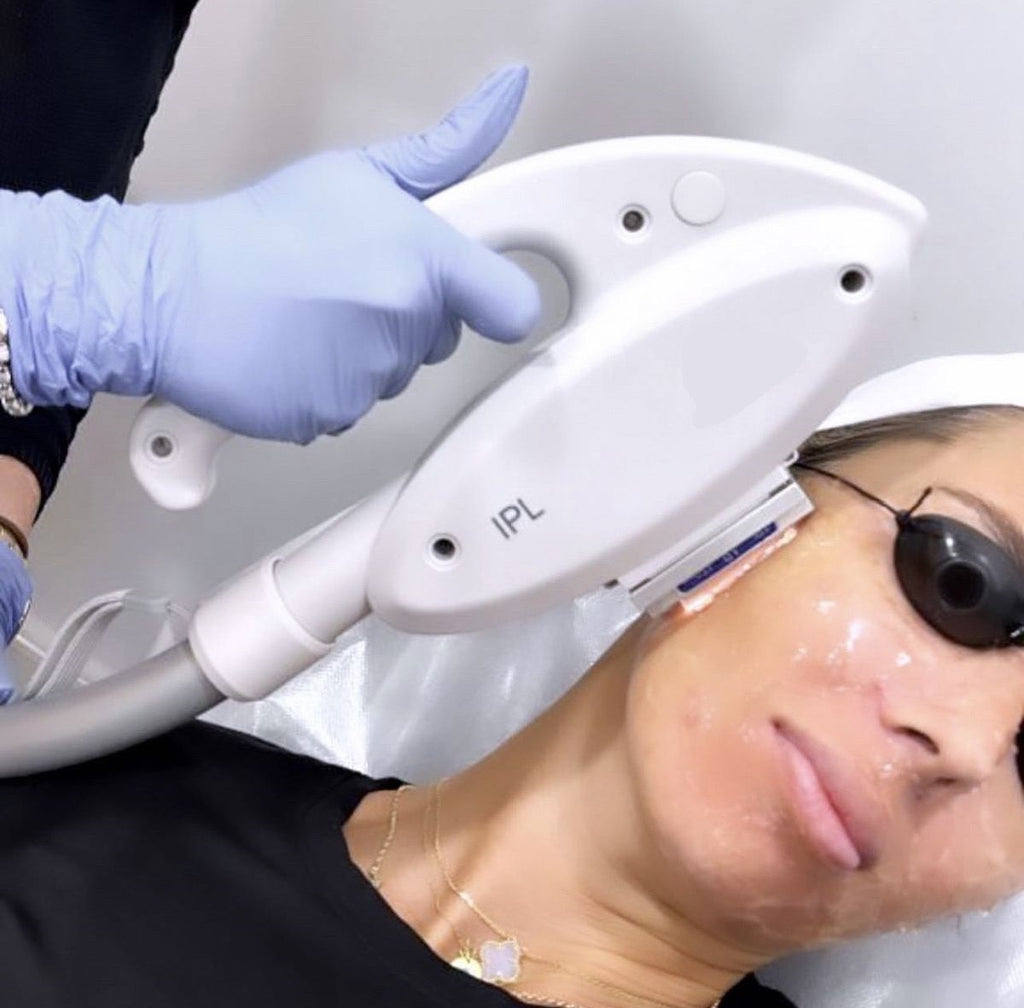 INTENSE PULSE LIGHT (IPL) SKIN REJUVENATION
